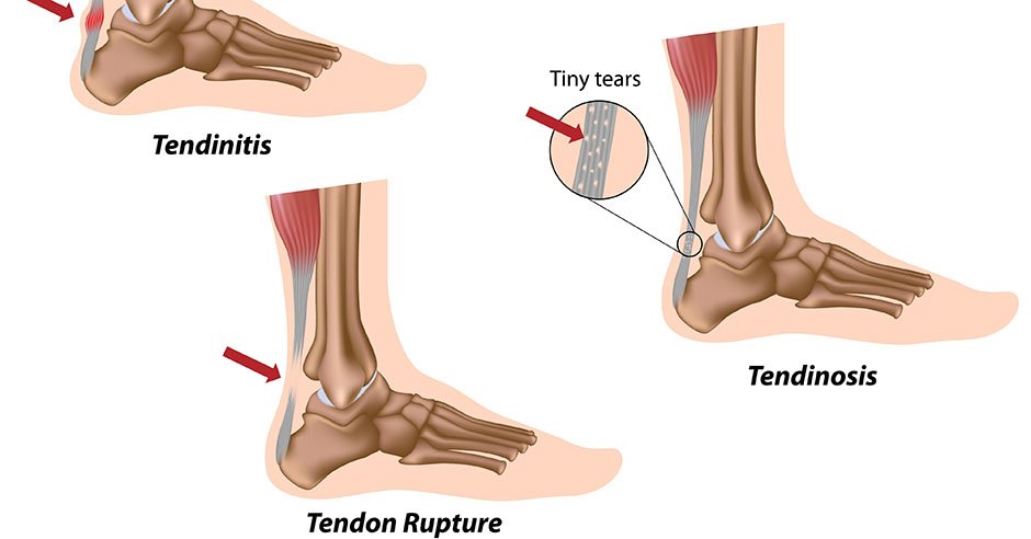 What is an Achilles Tendon Injury?