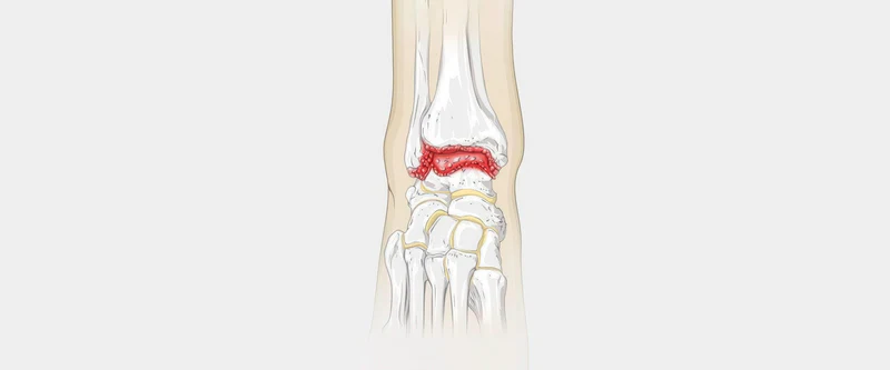 What is Ankle Arthritis?