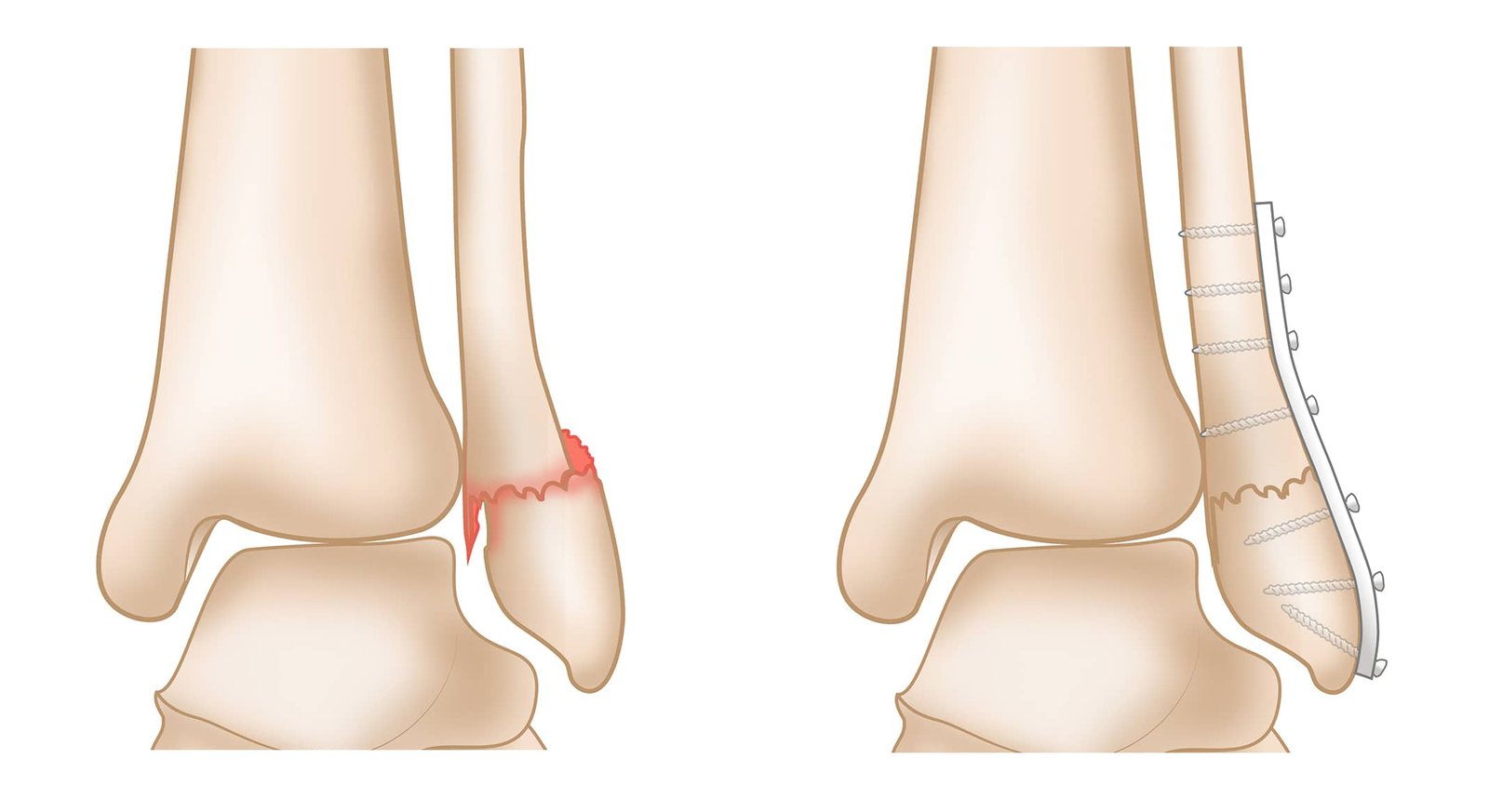 What is an Ankle Fracture?