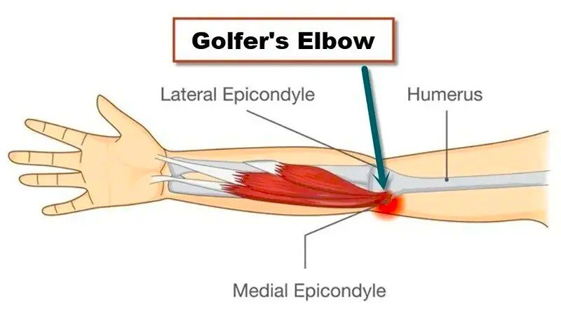 What is Golfer's Elbow?