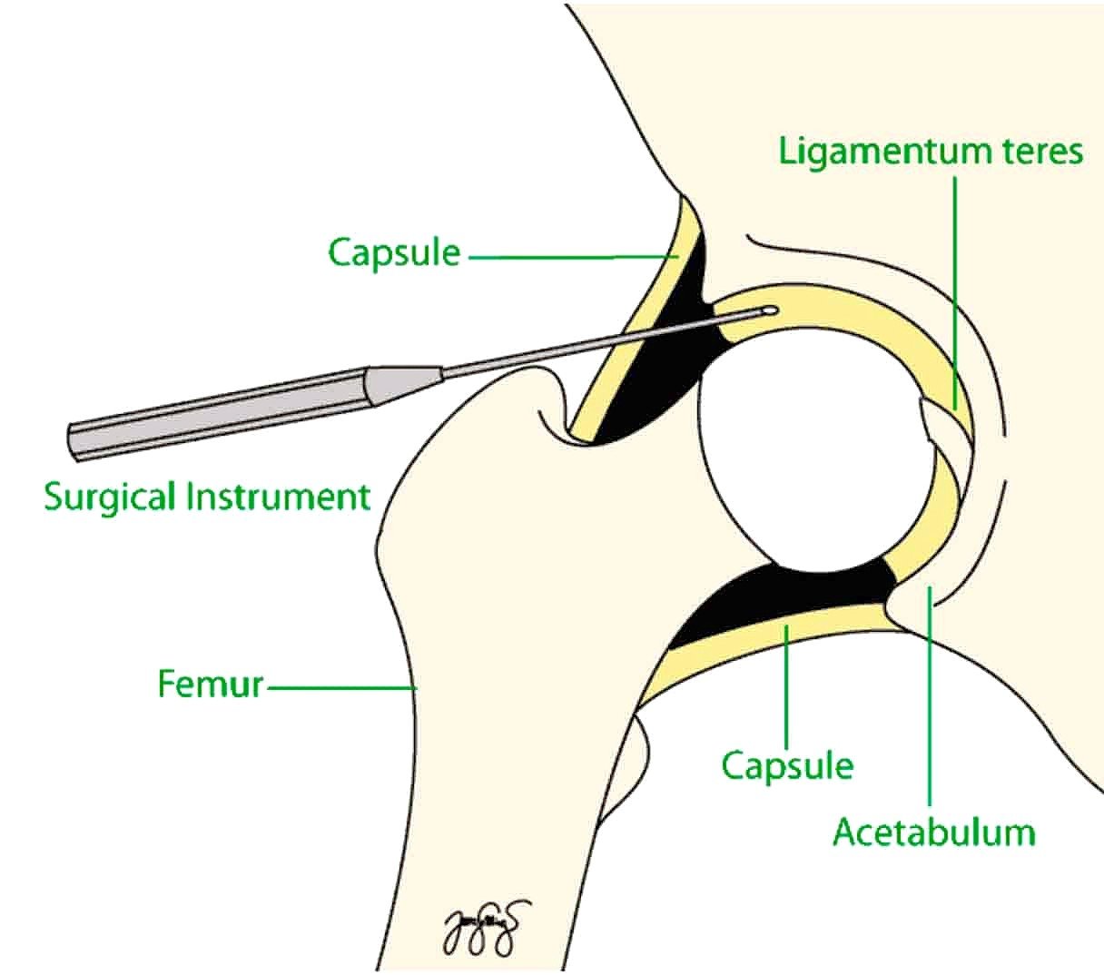 What conditions can be treated with Hip Arthroscopy?