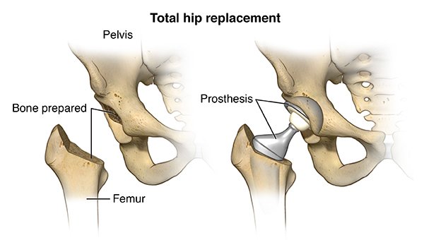 What is Hip Replacement Surgery?