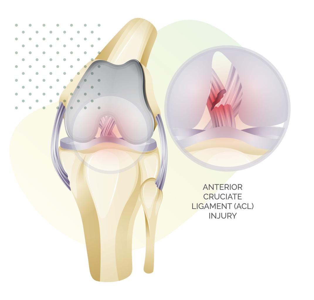 What is an ACL Injury?