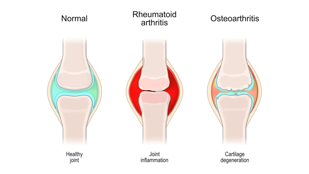 What is Knee Cartilage?