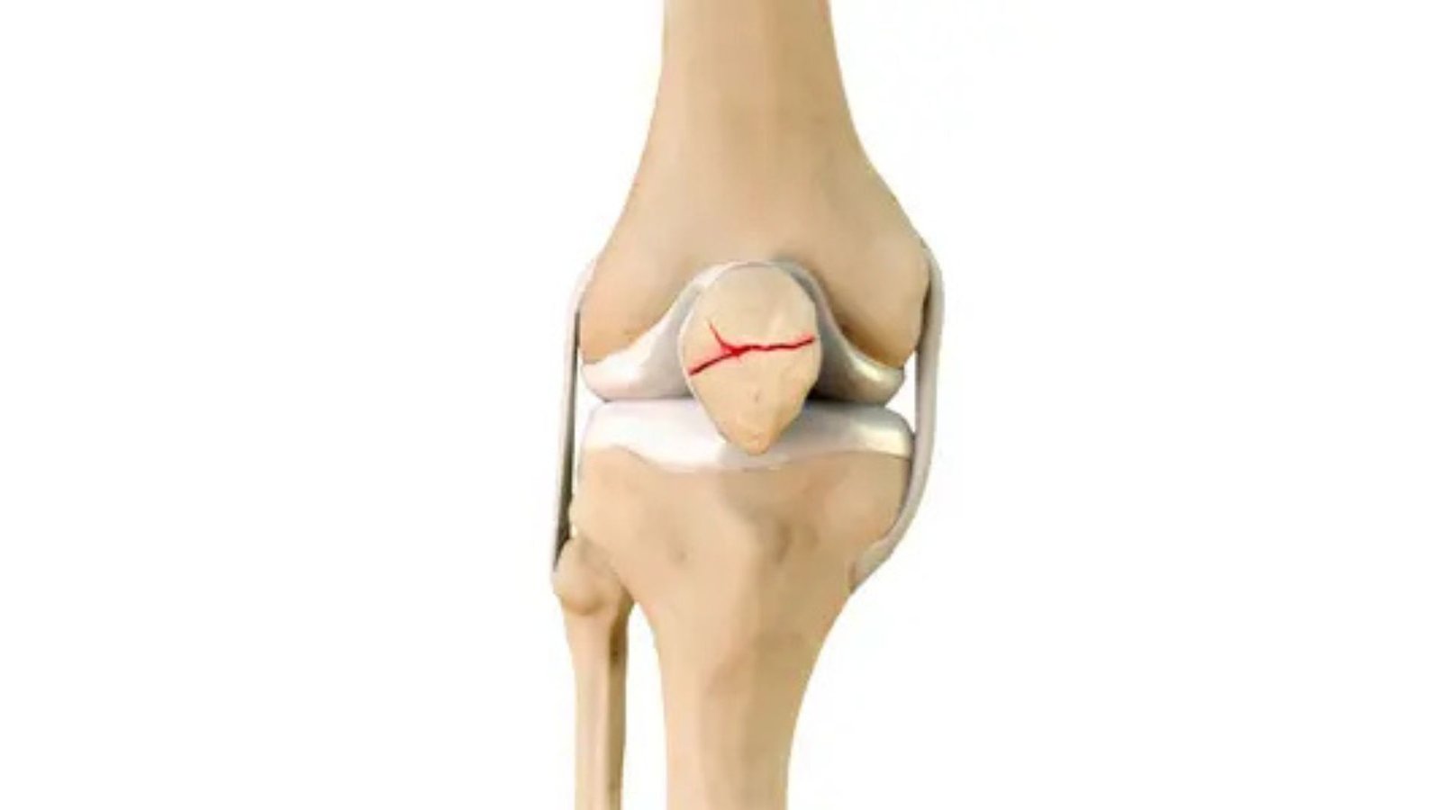 What causes Knee Joint Fractures?