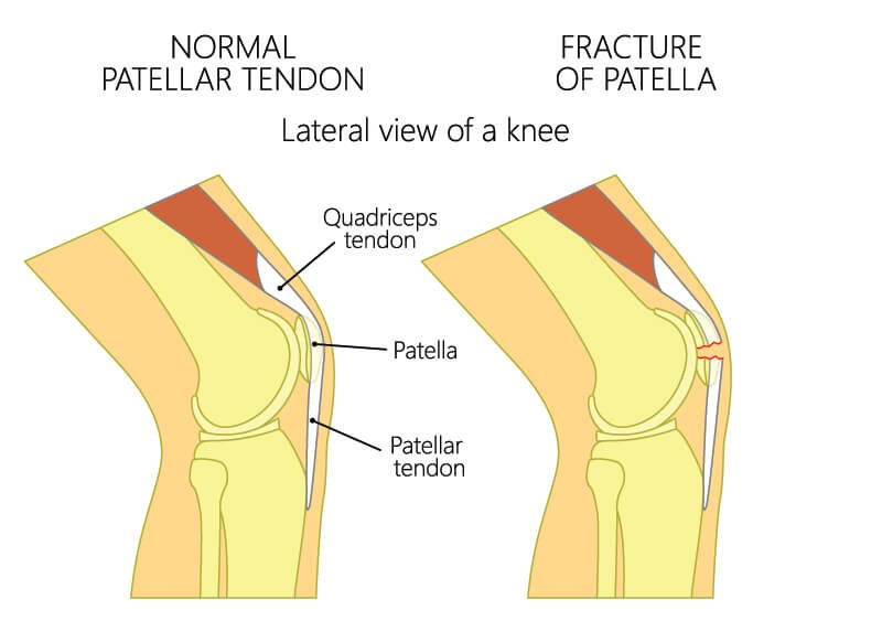 How is a Knee Joint Fracture diagnosed?