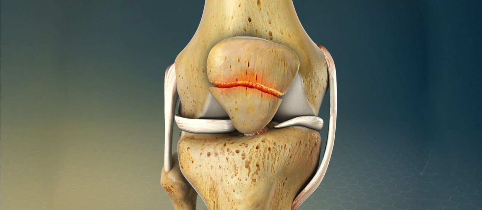 What is a Knee Joint Fracture?