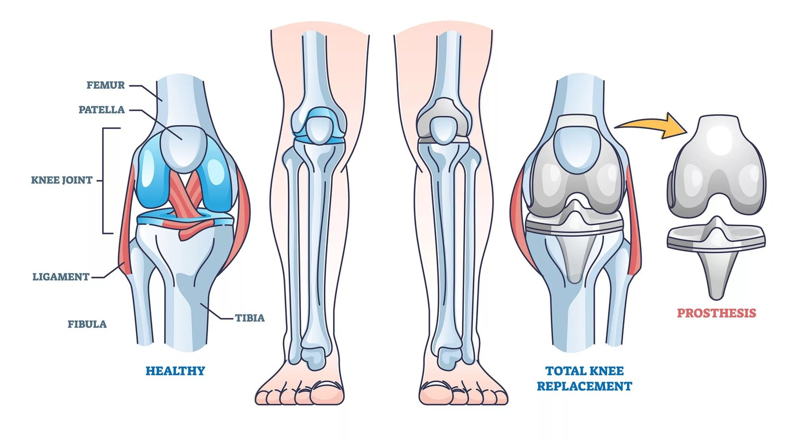 What is Knee Replacement Surgery?