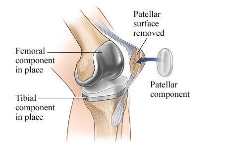 What are the types of Knee Replacement Surgery?