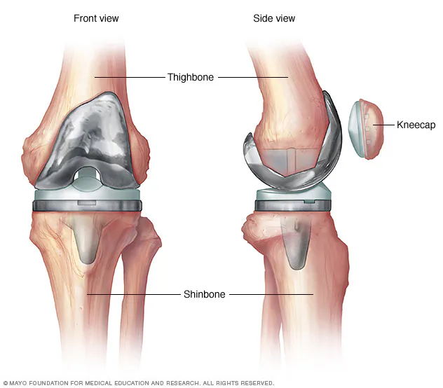 What are the types of Knee Replacement Surgery?