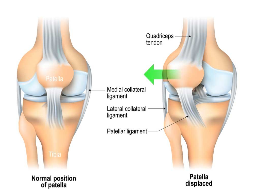 What is patellar instability?