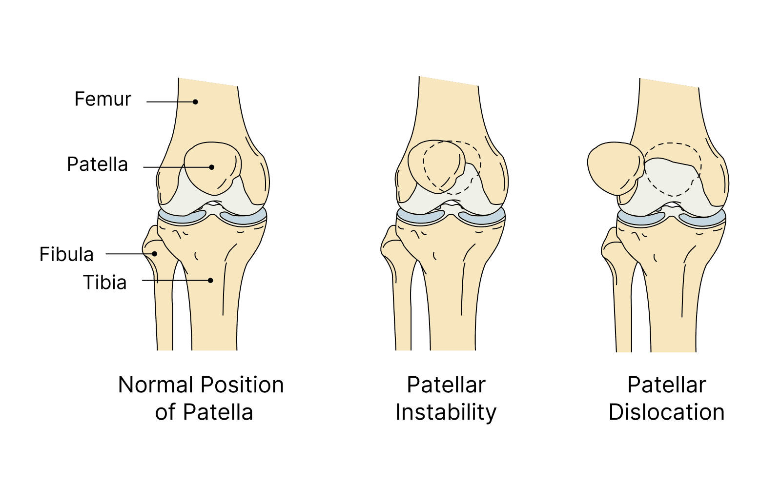 What causes patellar instability?