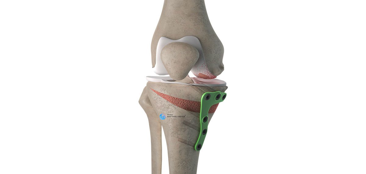 What is Knee Joint Preservation (Osteotomy)?