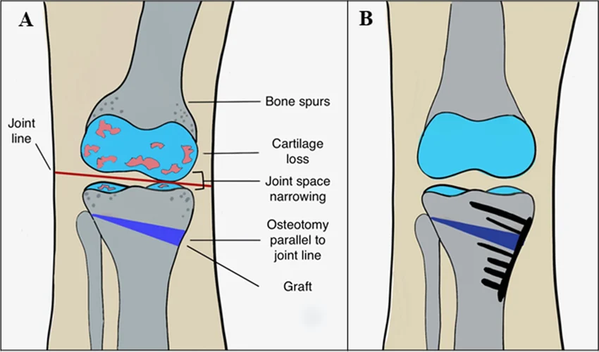 What is Knee Joint Preservation (Osteotomy)?