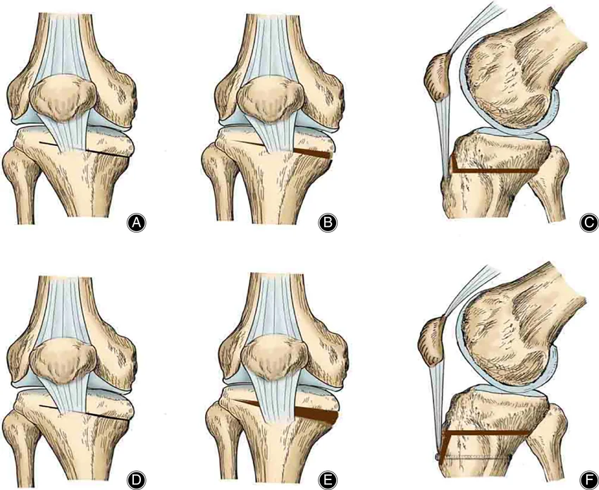 When is Osteotomy Recommended?
