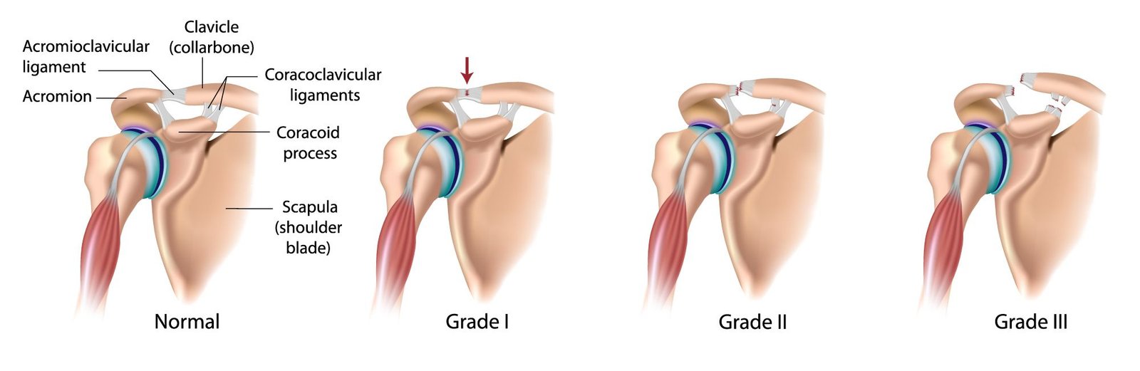 What is an AC Joint Injury?