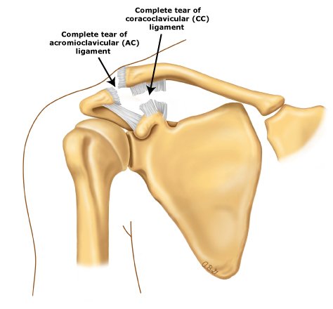 What are the treatment options for AC Joint Injury?