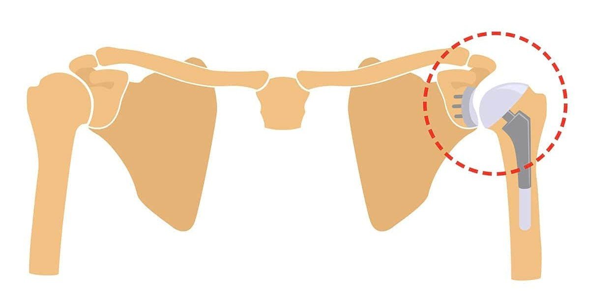 What is Reverse Shoulder Replacement?