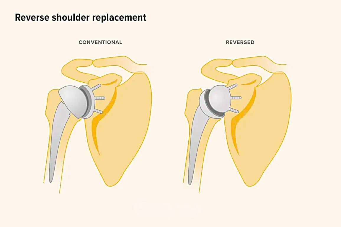 Who needs Reverse Shoulder Replacement?