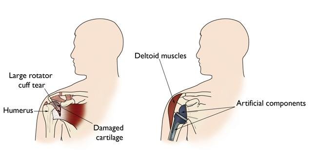 How is Reverse Shoulder Replacement performed?