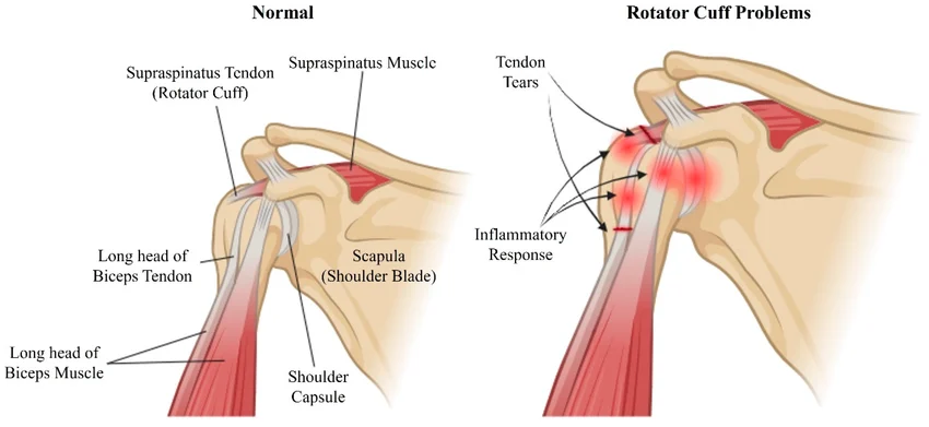 What is a Rotator Cuff Tear?