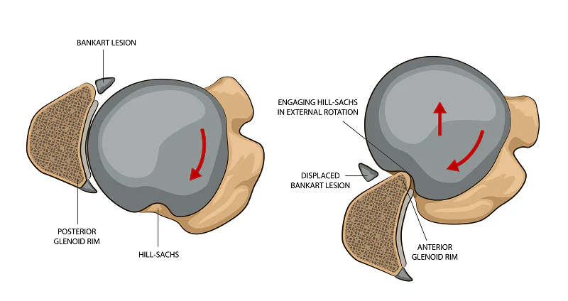 What is Shoulder Instability?