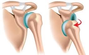 What causes Shoulder Instability?