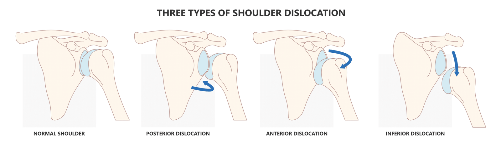 What are the treatment options for Shoulder Instability?