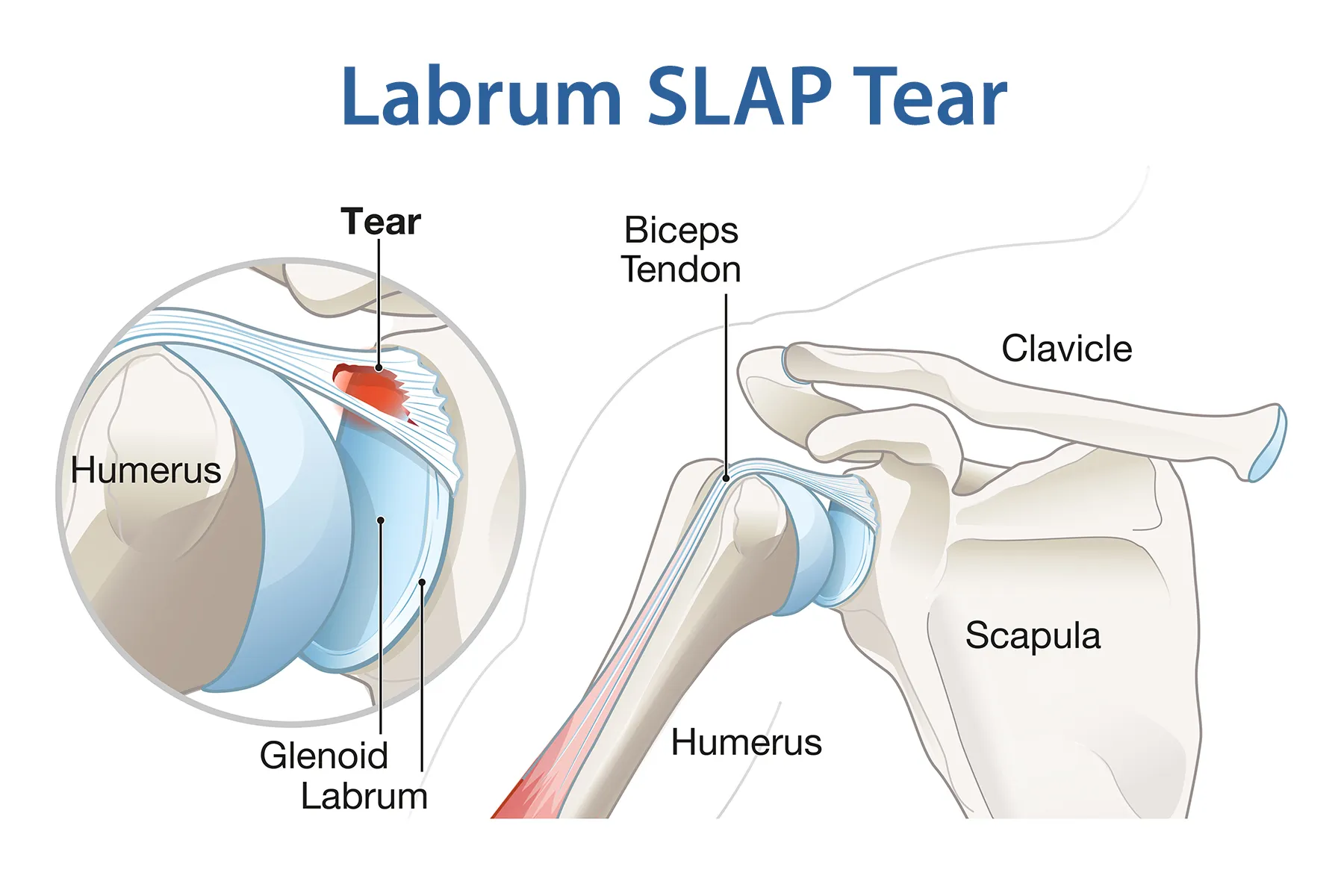 What is a SLAP Tear?
