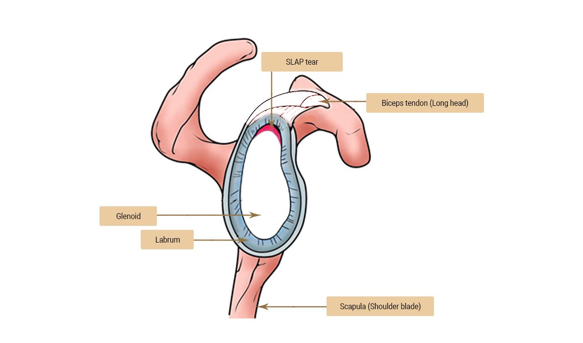 How is a SLAP Tear diagnosed?