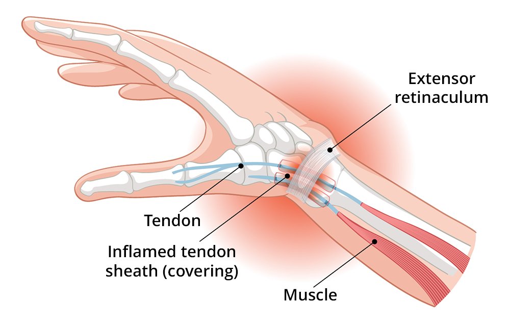 What is De Quervain's Tenosynovitis?
