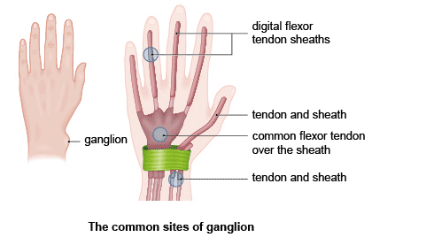 What is a Ganglion Cyst?