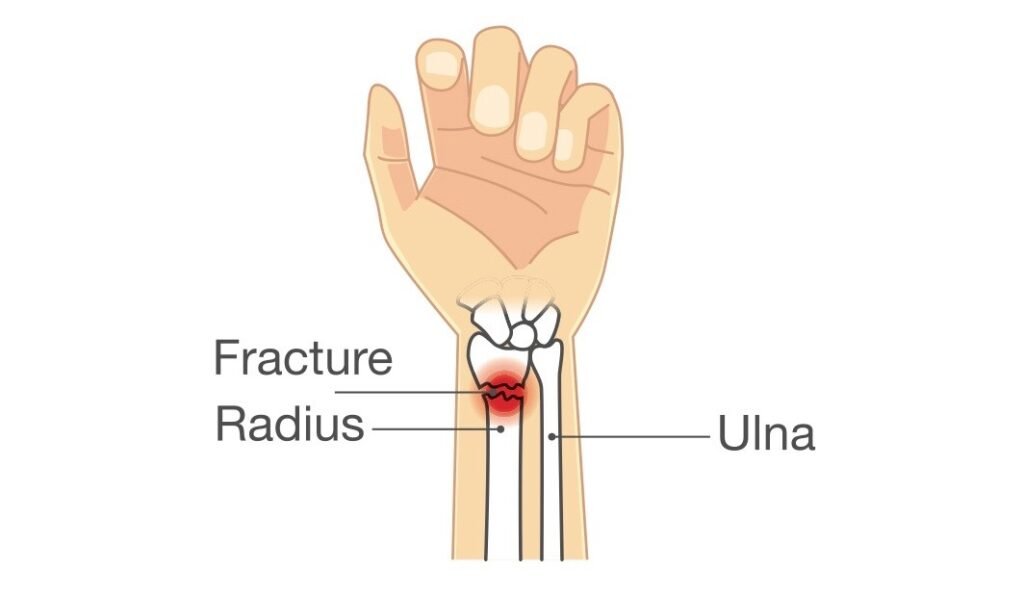 What is a Wrist Fracture?